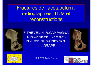 Fractures de l`acétabulum : radiographies, TDM et reconstructions