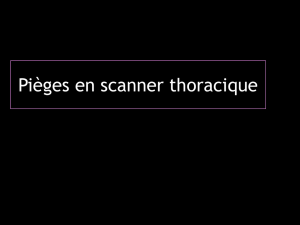 D TF pièges en scanner thoracique DR