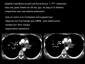 D CC thorax sarcome artère pulmonaire