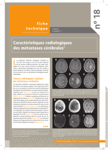 Caractéristiques radiologiques des métastases cérébrales