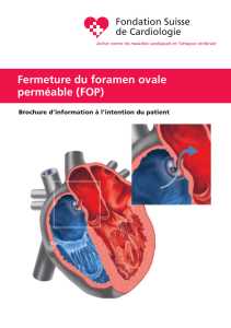 Fermeture du foramen ovale perméable (FOP)