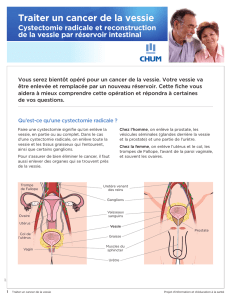 Traiter un cancer de la vessie - Cystectomie radicale et