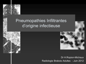 pneumopathies infiltrantes-infectieuses