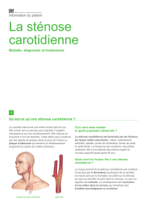 La sténose carotidienne - Centre Cardio