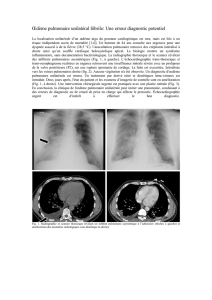 Œdème pulmonaire unilatéral fébrile: Une erreur