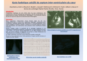 cœur ventriculaire du - Kyste hydatique calcifié du septum inter