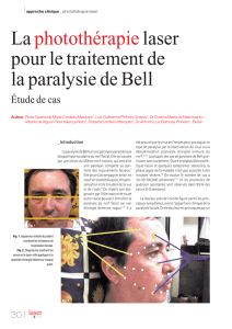 La photothérapie laser pour le traitement de la paralysie de Bell