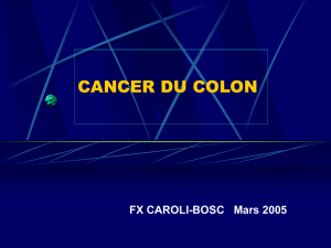 cancer du colon