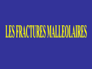 Fractures malléolaires