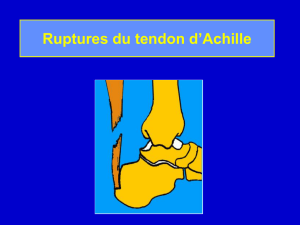 Ruptures du tendon d`Achille
