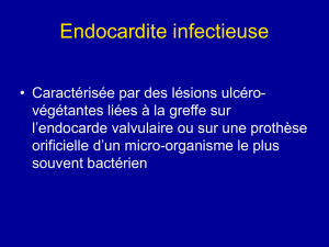 Endocardite infectieuse - Bienvenue chez Pierre