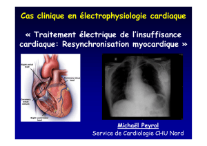 Cas clinique en électrophysiologie cardiaque « Traitement