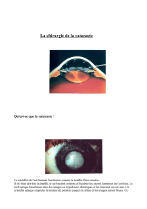 La chirurgie de la cataracte