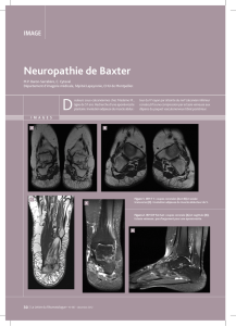 Neuropathie de Baxter