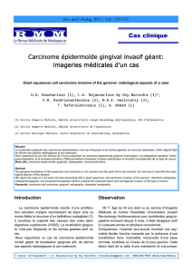 Carcinome épidermoïde gingival Carcinome