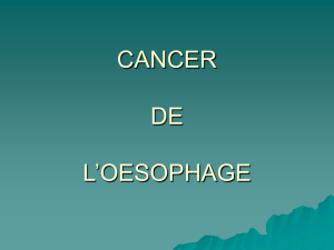 CANCER DE L`OESOPHAGE