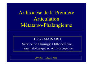 Arthrodèse métatarso-phalangienne du 1er rayon