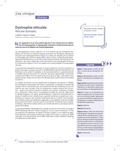GénétiqueDystrophie réticulée – Reticular dystrophy