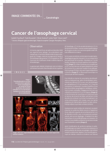 Cancer de l`œsophage cervical