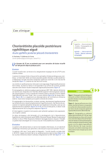 U Choriorétinite placoïde postérieure syphilitique aiguë Cas clinique