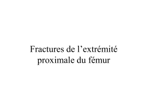 Fractures de l’extrémité proximale du fémur