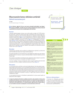 U Macroanévrisme rétinien artériel  Cas clinique Retinal macroaneurysm 
