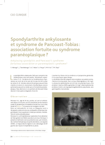 Spondylarthrite ankylosante et syndrome de Pancoast-Tobias : association fortuite ou syndrome paranéoplasique ?