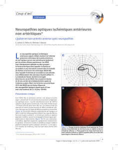 L Neuropathies optiques ischémiques antérieures non artéritiques* Coup d’œil