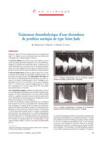 Traitement thrombolytique d’une thrombose de prothèse aortique de type Saint Jude C