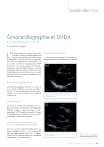L’ Échocardiographie et DVDA DOSSIER THÉMATIQUE Echocardiography in ARVD