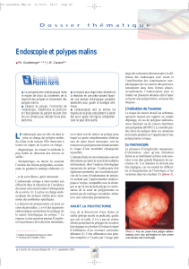 Endoscopie et polypes malins
