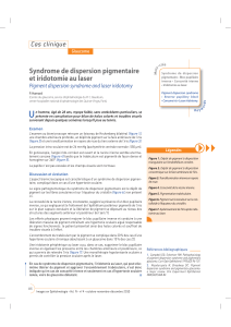 Syndrome de dispersion pigmentaire et iridotomie au laser Cas clinique