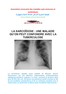 La-sarcoïdose, une maladie qu'on peut confondre avec la tuberculose - Ammais News