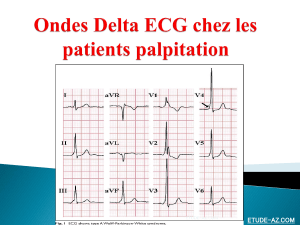 Ondes Delta ECG chez les patients palpitation