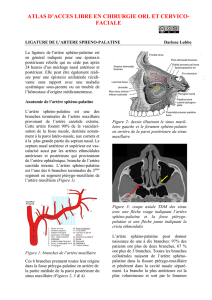Sphenopalatine artery (SPA) ligation - Vula