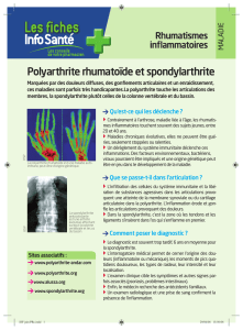 Polyarthrite rhumatoide et spondylarthrite : la fiche info santé