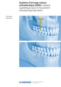 Système d`ancrage osseux orthodontique (OBA). Implants