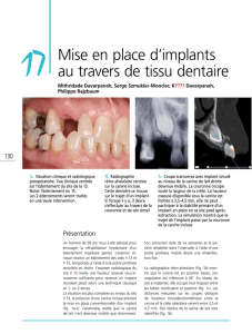 Mise en place d`implants au travers de tissu dentaire