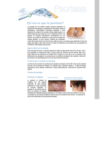 psoriasis site web-modifier(2 - Centre de dermatologie et de