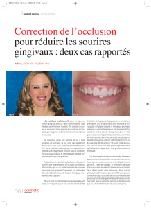 Correction de l`occlusion pour réduire les sourires gingivaux : deux