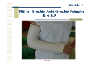 Plâtre Brachio Anté-Brachio Palmaire BABP