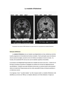 La maladie d`Alzheimer