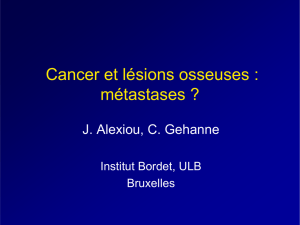 Cancer et lésions osseuses : métastases ?