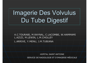 Imagerie Des Volvulus Du Tube Digestif
