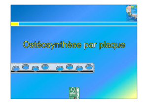 Ostéosynthèse par plaque - Euro