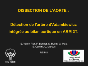DISSECTION DE L`AORTE : Détection de l`artère d`Adamkiewicz