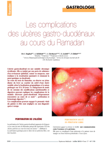 Les complications des ulcères gastro-duodénaux