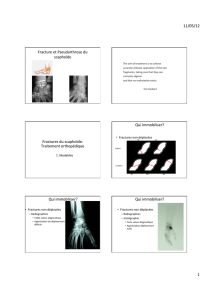 Fractures et pseudarthroses du scaphoïde - rhumatologie