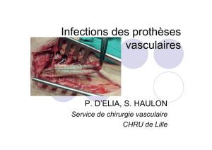 Infections des prothèses vasculaires - Infectio