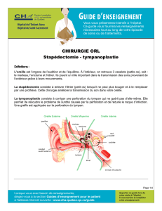 Stapédectomie - tympanoplastie. PDF / 2,9 Mo